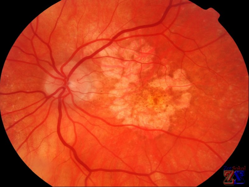 Изображение сухой формы патологии Изображение сухой формы патологии