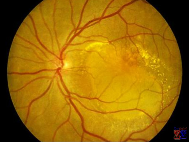 Снимок макулодистрофии Снимок макулодистрофии