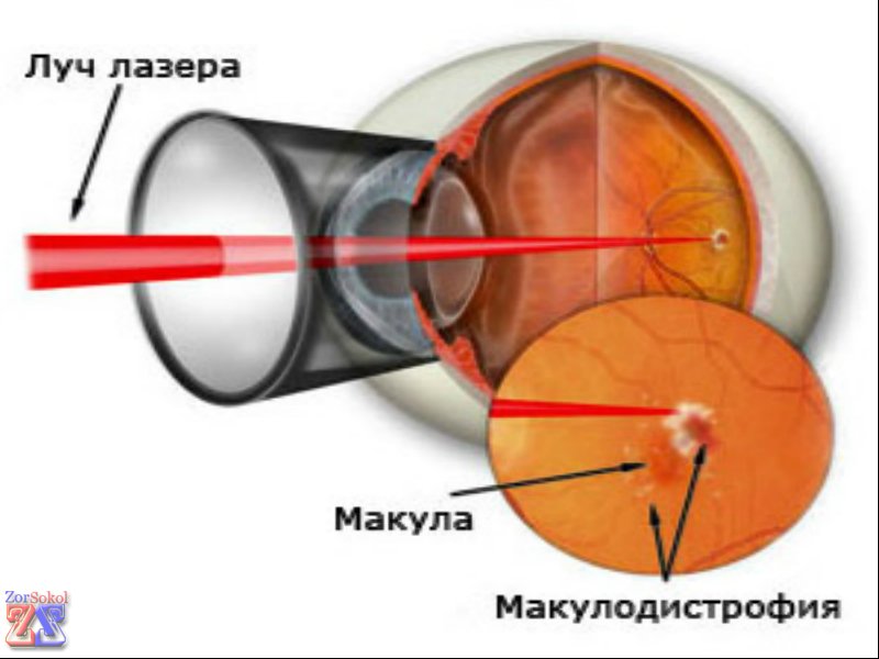 В лечении макулодистрофии применяется лазерное облучение В лечении макулодистрофии применяется лазерное облучение