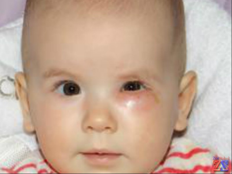 Наглядные симптомы воспаления Наглядные симптомы воспаления