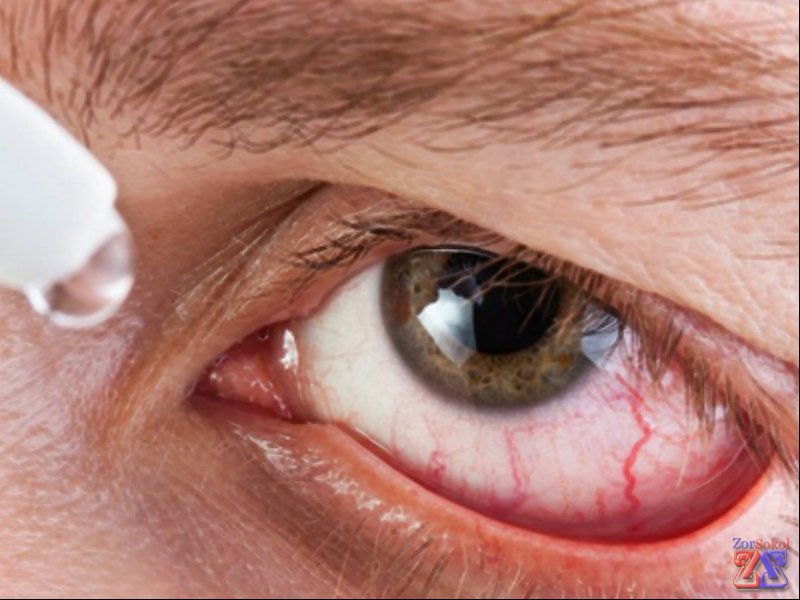 Действие Офтальмоферона распространяется на разные болезни глаз Действие Офтальмоферона распространяется на разные болезни глаз