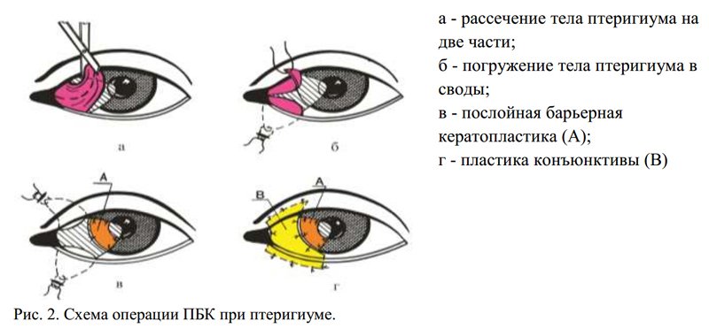 Удаление птеригиума