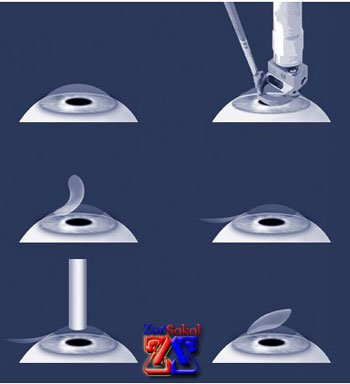 Этапы хирургической операции Этапы хирургической операции