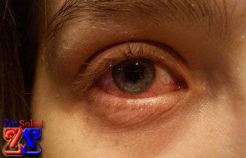 Воспаленная коньюнктива Воспаленная коньюнктива