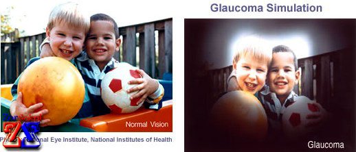 Взгляд здоровым глазом и больным глаукомой Взгляд здоровым глазом и больным глаукомой