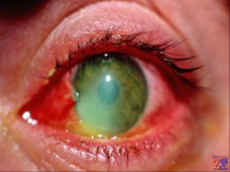 Признаки ожога бывают разными Признаки ожога бывают разными