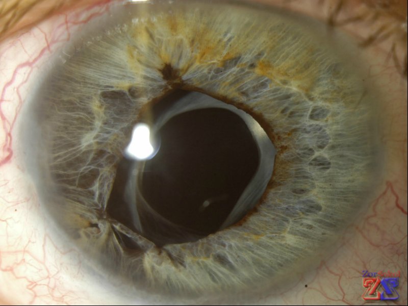 Правильное положение ИОЛ Правильное положение ИОЛ