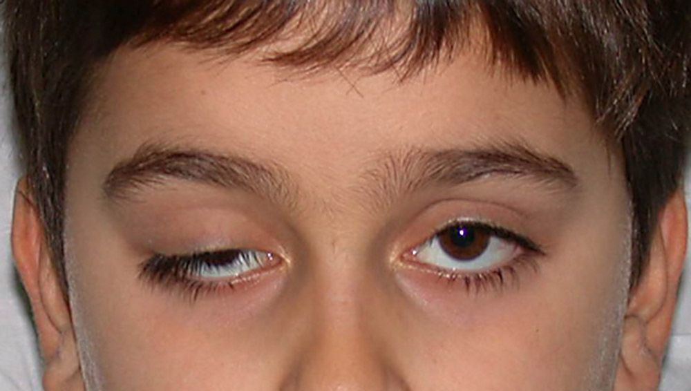 Полный птоз