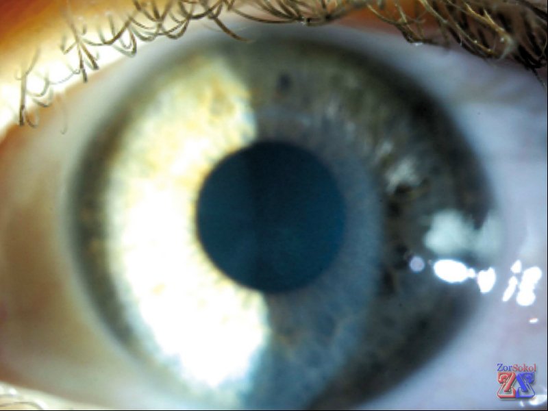 Отекшая роговица Отекшая роговица