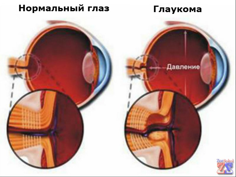 Как выглядит больной и здоровый глаз Как выглядит больной и здоровый глаз