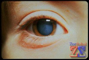 Так выглядит пораженный глаз Так выглядит пораженный глаз