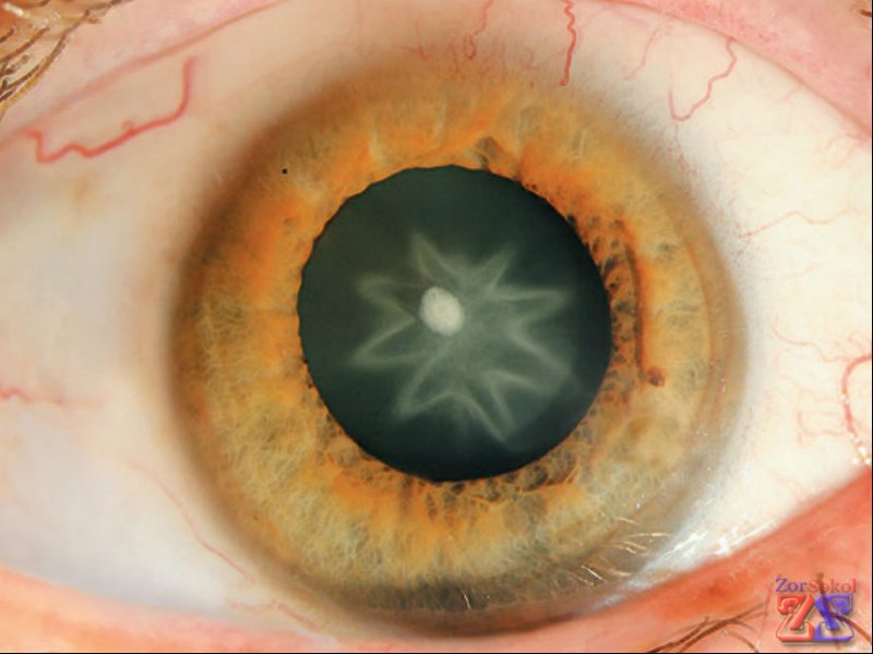 Помутнения в виде звезды Помутнения в виде звезды