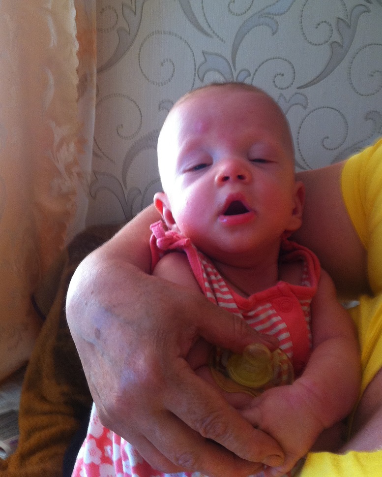 Птоз у ребёнка