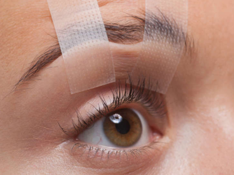 Придерживание опущенного века при помощи лейкопластыря