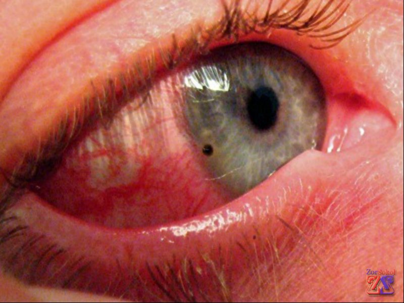 Повреждение роговой оболочки Повреждение роговой оболочки