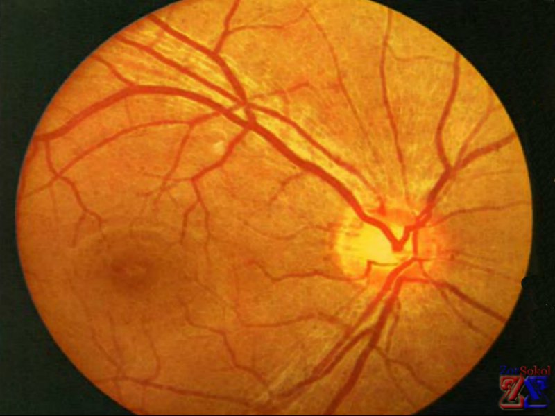 Так выглядят сосуды при ангиосклерозе Так выглядят сосуды при ангиосклерозе