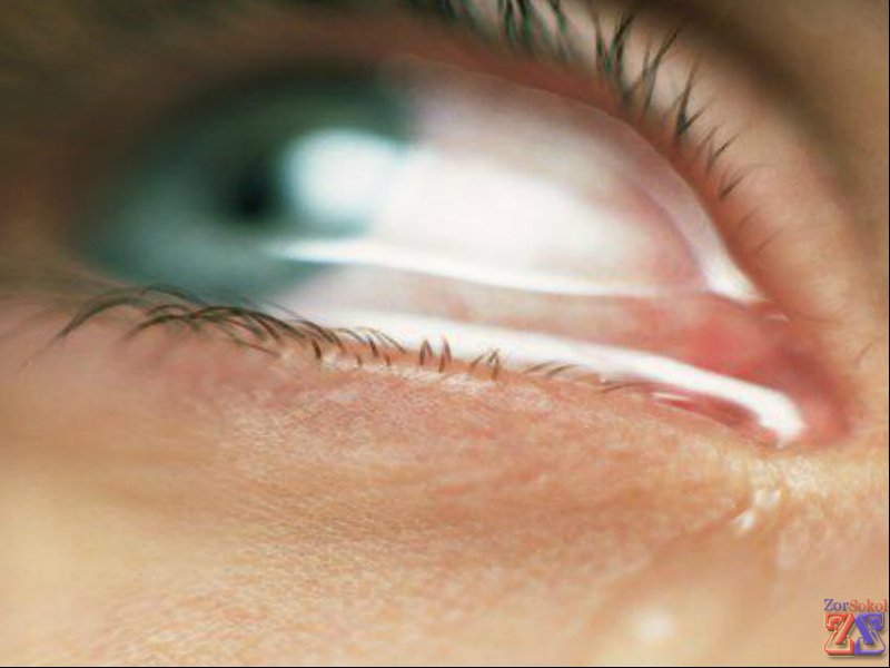 Несовместимость раствора и КЛ может привести к осложнениям Несовместимость раствора и КЛ может привести к осложнениям