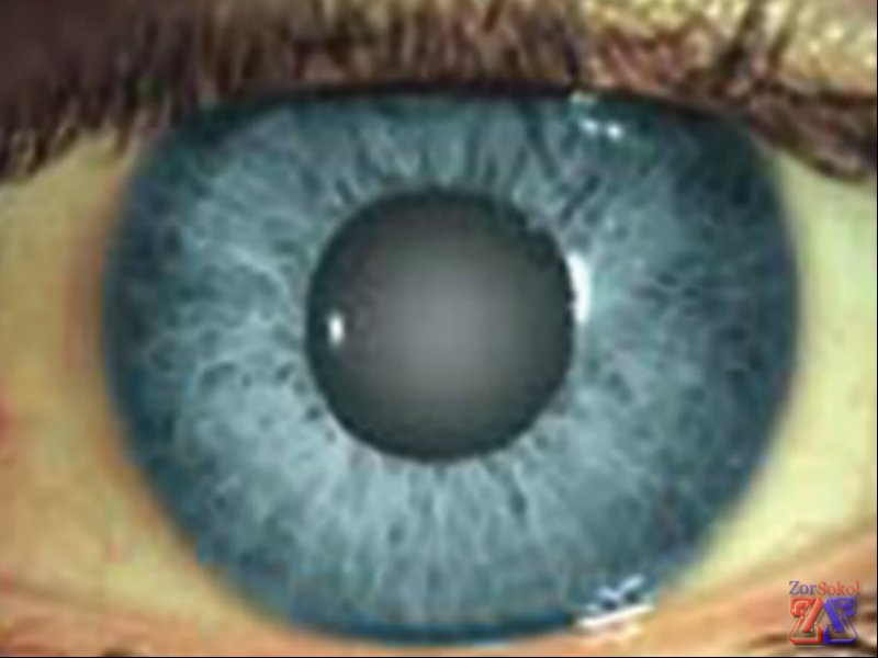 Мутно-серый зрачок Мутно-серый зрачок