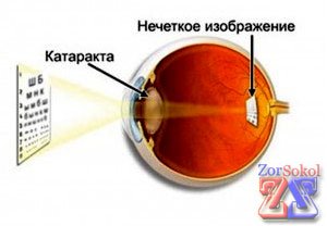 Различные виды катаракты Различные виды катаракты
