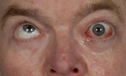 Синдром Горнера