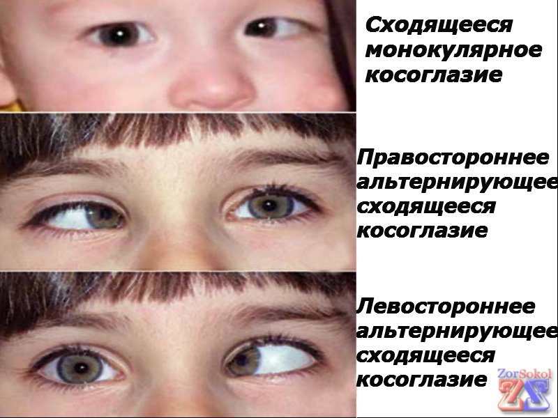 Некоторые виды косоглазия Некоторые виды косоглазия