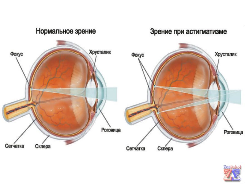 Разница между глазами: здоровым и астигматичным Разница между глазами: здоровым и астигматичным