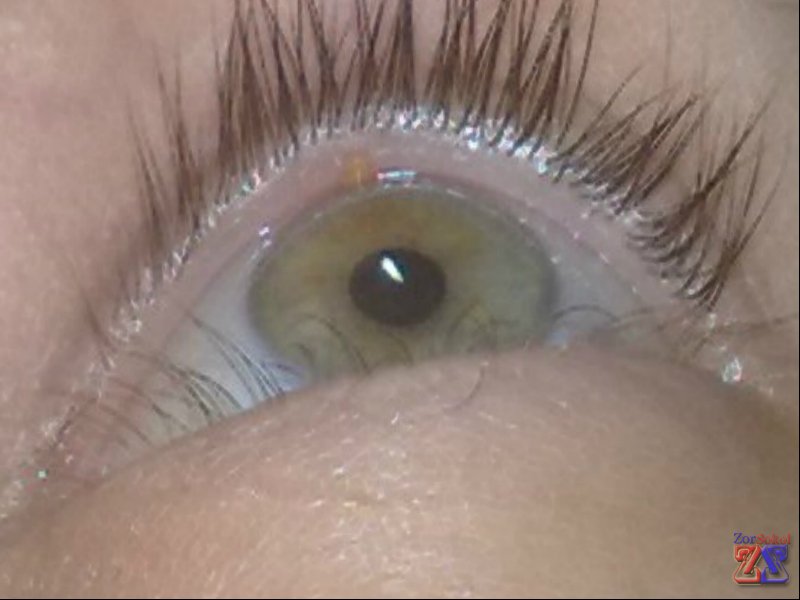 Перед закапыванием нужно снимать контактные линзы Перед закапыванием нужно снимать контактные линзы