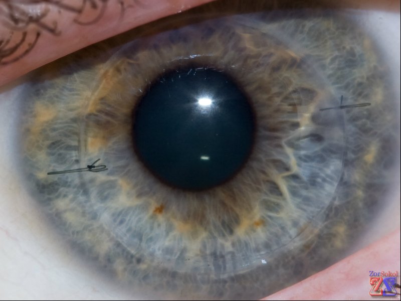 Показания: дистрофия и травмы роговицы, катаракта Показания: дистрофия и травмы роговицы, катаракта