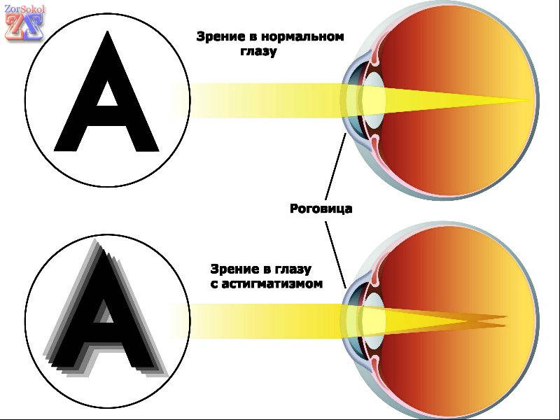 Так видит астигматик Так видит астигматик