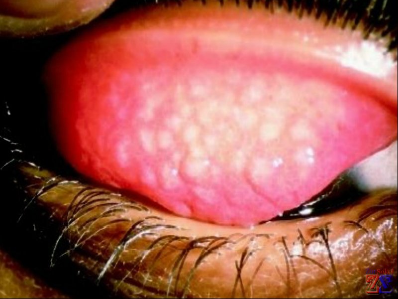 После трахомы на конъюнктиве остаются рубцы После трахомы на конъюнктиве остаются рубцы