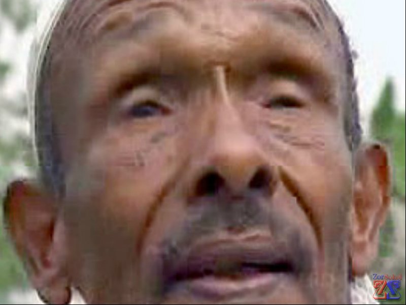 Одно из осложнений трахомы - симблефар Одно из осложнений трахомы - симблефар