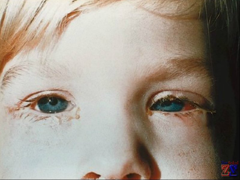 Одно из показаний - конъюнктивит Одно из показаний - конъюнктивит