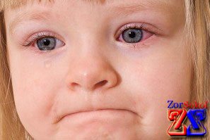 Больной левый глазик Больной левый глазик