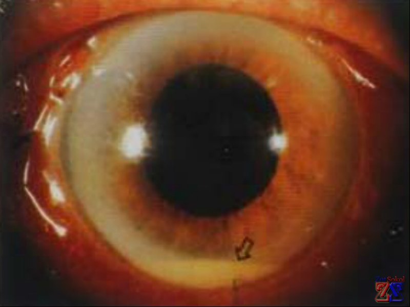 Гнойный иридоциклит Гнойный иридоциклит