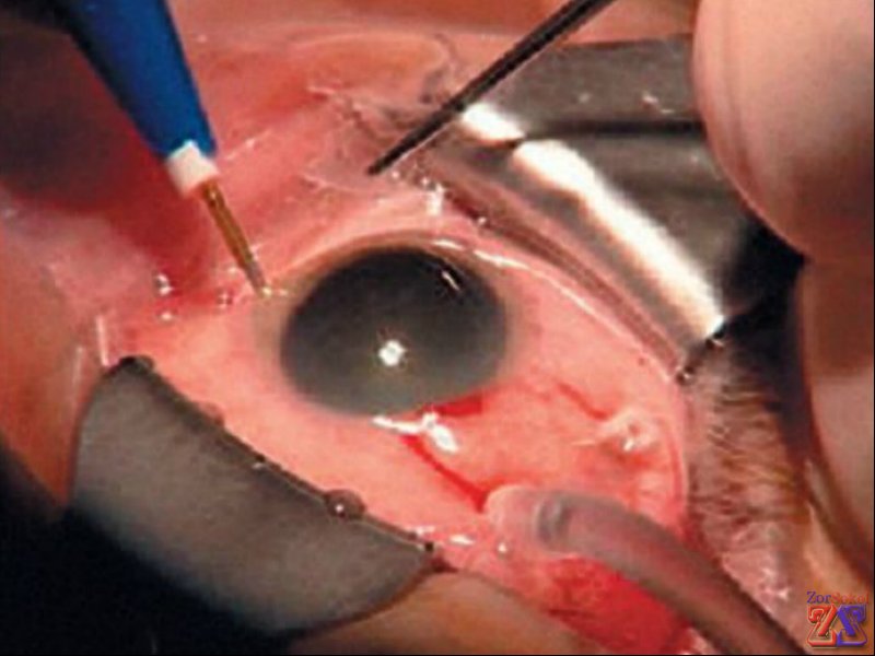 Витрэктомия Витрэктомия