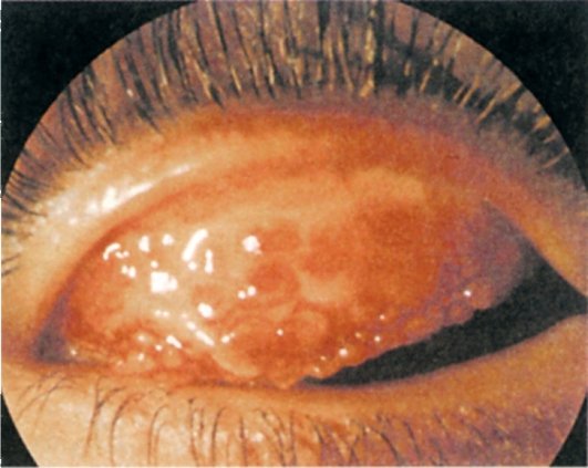 Весенний катар