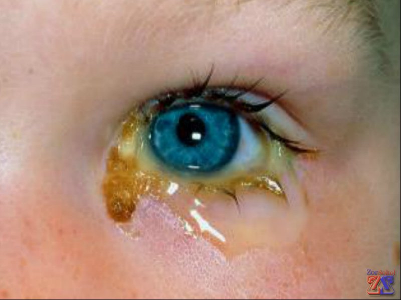 Вегамоксом лечат конъюнктивит Вегамоксом лечат конъюнктивит