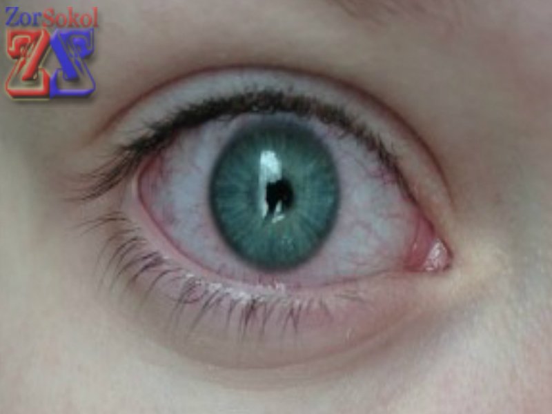 Воспаленная конъюнктива Воспаленная конъюнктива