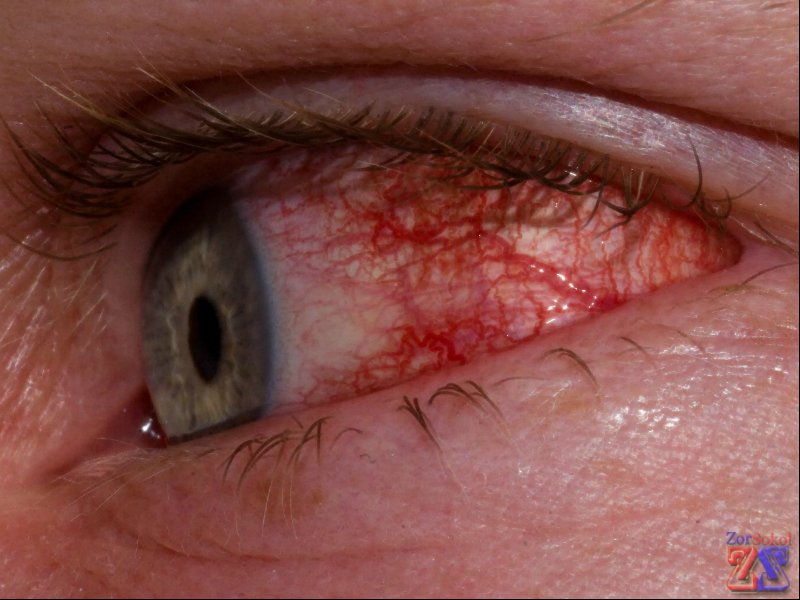 Первый признак воспаления - покраснение глаз Первый признак воспаления - покраснение глаз