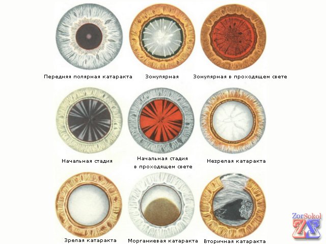 Виды катаракты Виды катаракты