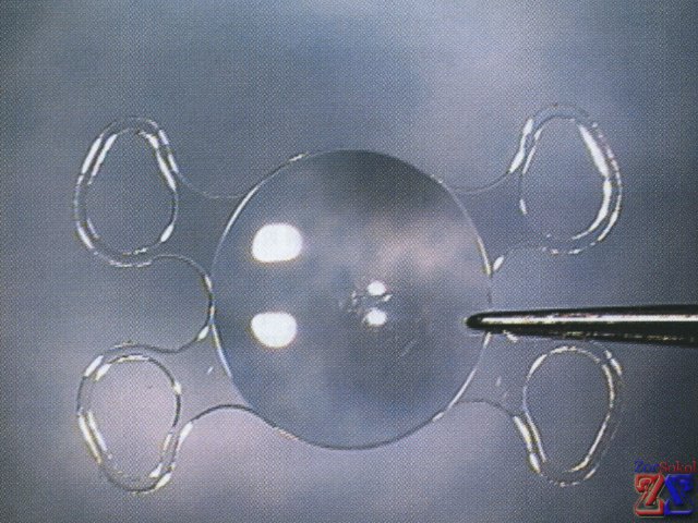 Заднекапсулярная интраокулярная линза Заднекапсулярная интраокулярная линза