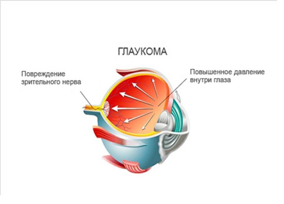 вторичная глаукома