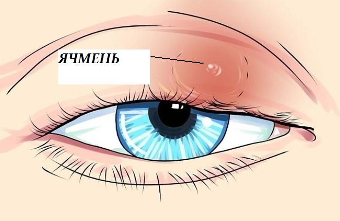 Ячмень на верхнем веке