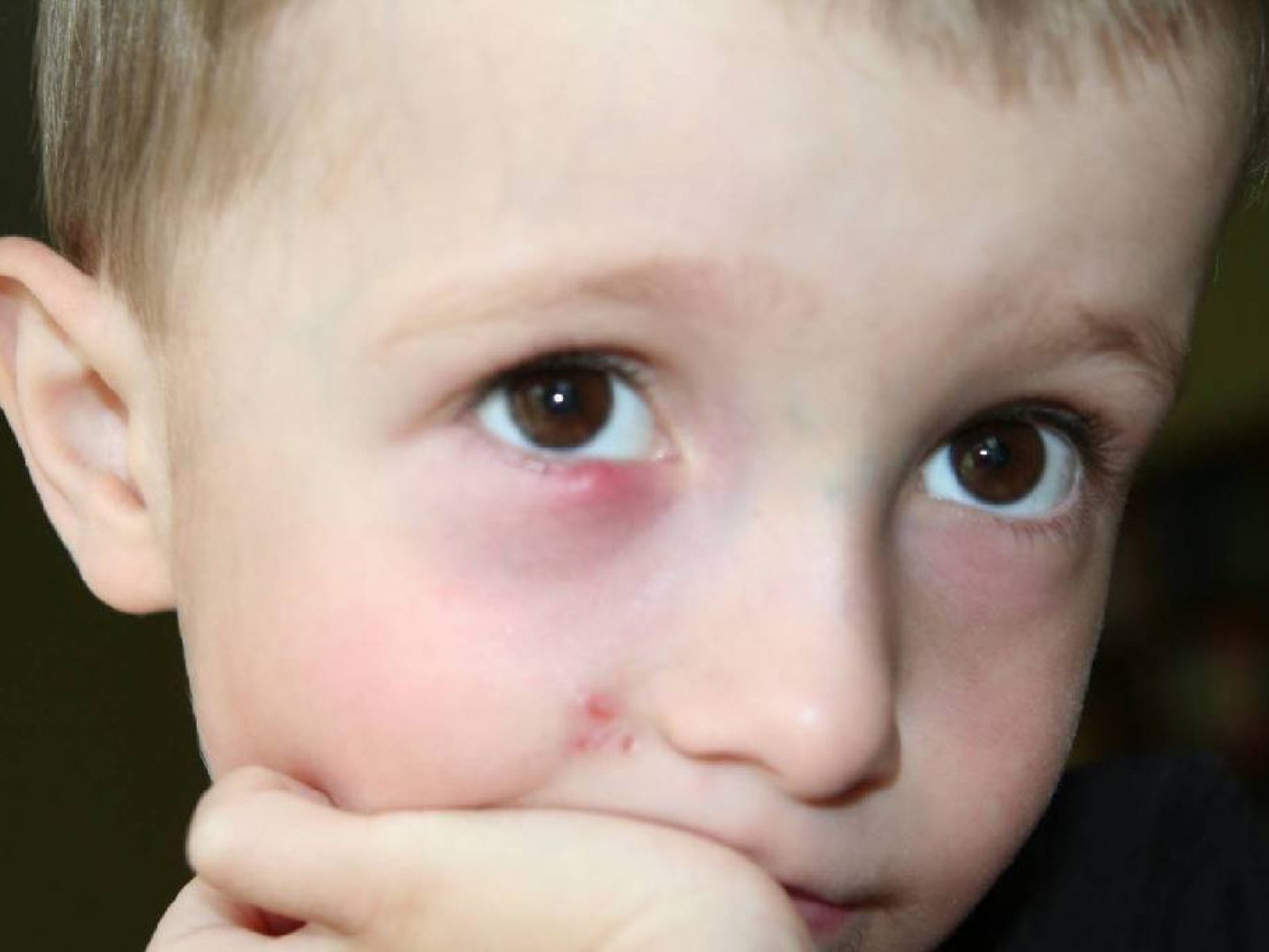 Ячмень на глазу ребёнка