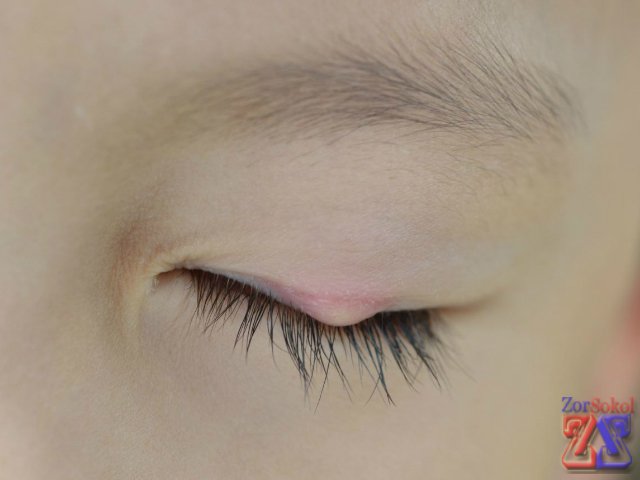 Признаки ячменя Признаки ячменя