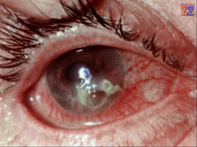 Вид язвы на человеческом глазу Вид язвы на человеческом глазу